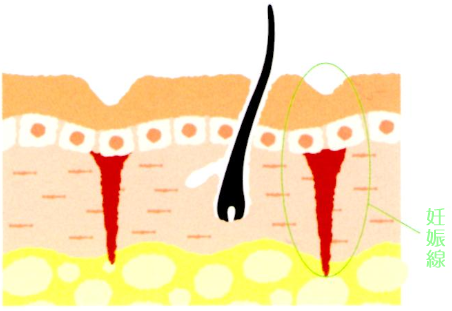 妊娠線ができた皮膚の断面図
